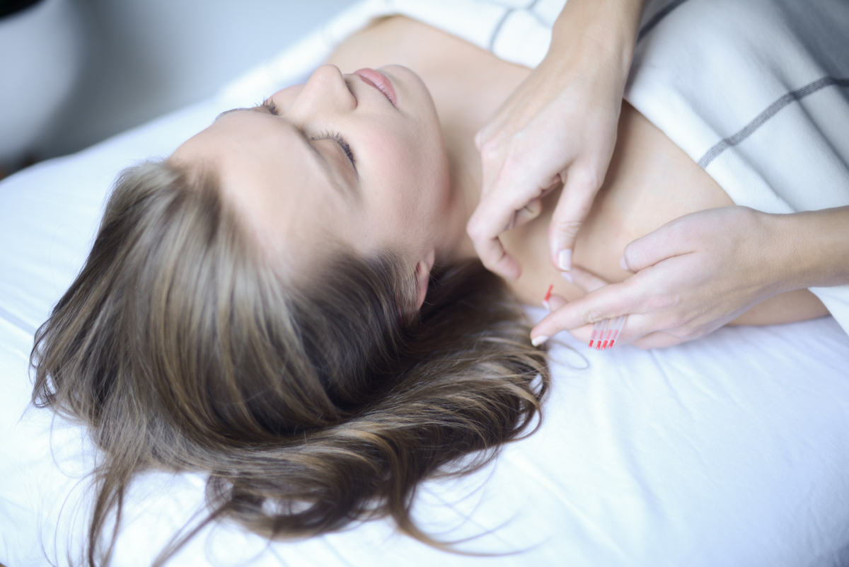Acupuncture
