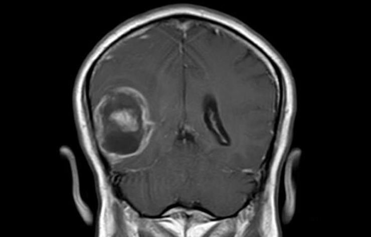 glioblastoma