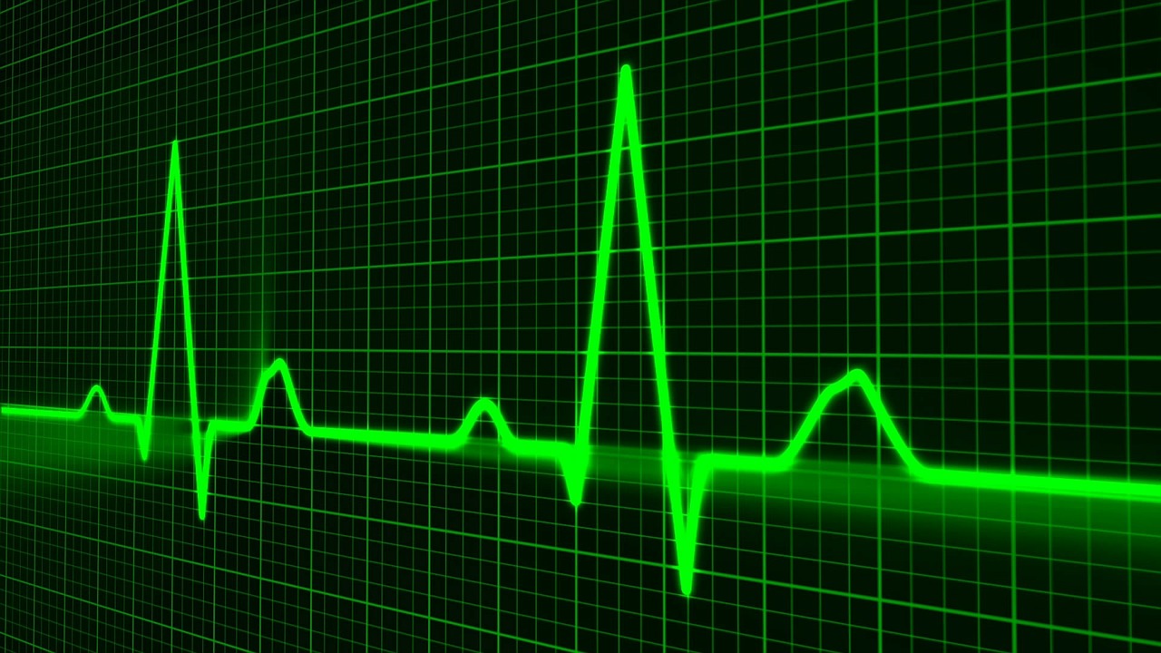 EKG rhythm