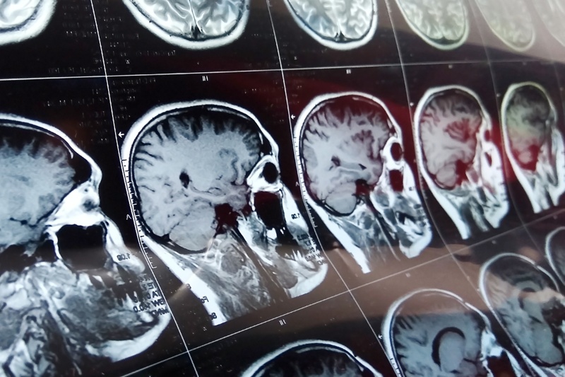 MRI brain scan